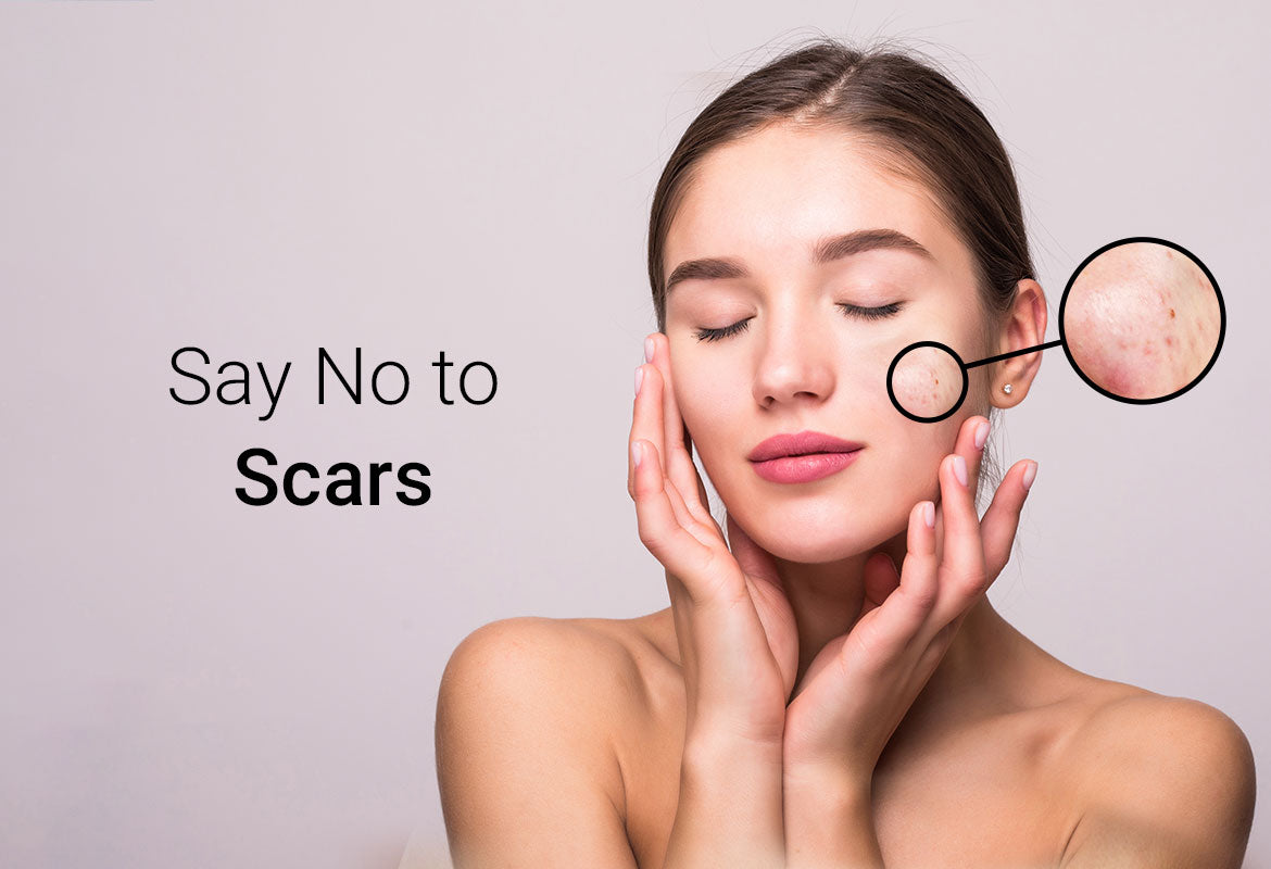 Say no to acne scars